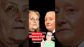 SHOCKING CHEMICAL PEEL BEFORE AND AFTER  Phenol Peel shorts [upl. by Schwab]