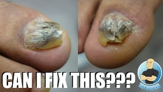 TRYING TO FIX A DAMAGED amp DEFORMED BIG TOENAIL [upl. by Ahsaela]