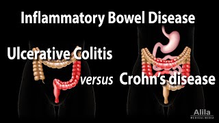 Ulcerative Colitis versus Crohns Disease Animation [upl. by Erreipnaej627]