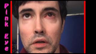 Severe Bacterial Pink Eye Conjunctivitis treatment part 2 [upl. by Sabu]