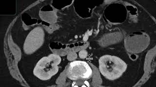 Gallstone ileus [upl. by Trev]