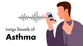 Sounds of Asthma  Wheezing Lung Sounds [upl. by Nomar721]