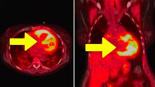 Young Man Takes BrandNew Vitamin K2 Supplement This Happened To His Heart [upl. by Notyap]