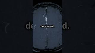 New Discovery Brain Wiring amp Depression [upl. by Theron]