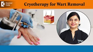 How to freeze and remove warts  Wart Removal Using Cryotherapy  Dr Amee Daxini  Doctors Circle [upl. by Hegarty695]