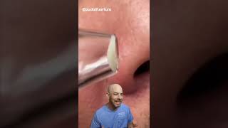 I wouldn’t recommend a pore vacuum 🛑 credit zudaifuarturo on TT doctor satisfying viral [upl. by Ycnan]