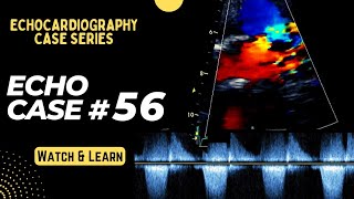 Echo Case 56 Echocardiography Spot Diagnosis Series  Cardiology  Educational Video [upl. by Maddock]