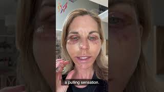 My Advanced Facelift Recovery Day by Day  Real Stories By Real Patients 2022 [upl. by Yrrot]