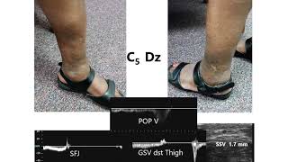 Popliteal Vein Compression  Virtual Vascular Lab Channel [upl. by Malone858]