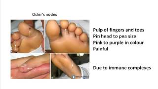 Oslers nodes and Janeway lesions [upl. by Navonoj935]