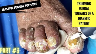 Massive Fungal Toenails  Trimming Fungal Toenails of a Diabetic Patient  Part 3 Podiatry [upl. by Elohcan900]