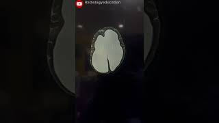 😱Hydrocephalus in brainshortsvideo radiology viral shortshorts hydrocephalus medicalmrict [upl. by Marylee]