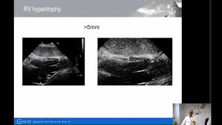 Echokardiographie bei Pulmonaler Hypertonie  Charité  Prof Dr med Frank Edelmann [upl. by Sharia238]