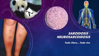 SARCOIDOSIS Y NEUROSARCOIDOSIS Todo claro todo rico [upl. by Sinclair77]