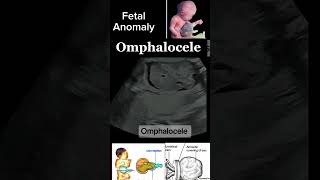 Prenatal Imaging of Omphalocele A Detailed Case Study casestudy anomally shorts DrSaimakhan [upl. by Rebeh]