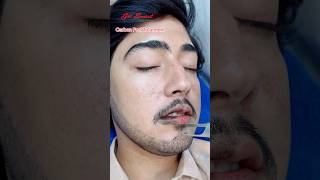 Carbon Peel Laser Treatment getsmarthairclub viralvideo beauty laserhairtreatment laser [upl. by Buatti656]