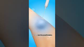 How Ganglion Cyst Removal Surgery Works shorts viralvideo  Creativelearning3d [upl. by Karina509]