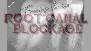 1 minute clinical canal blockage tips [upl. by Eelorac]