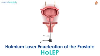 What is Holmium Laser Enucleation of the Prostate l Manipal Hospitals Bengaluru [upl. by Sitoiyanap]