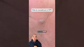 Esto no es un CALLO es VPH medicina Vph shorts [upl. by Alyacim103]