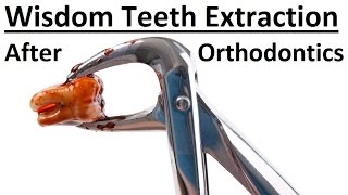 Why Is It Sometimes Recommended To Extract Wisdom Teeth After Orthodontic Treatment by Dr Mike Mew [upl. by Robma]