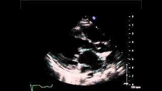 Coronary Sinus Atrial Septal Defect Parastermal Long Axis View with Dilated Coronary Sinus [upl. by Anaira337]