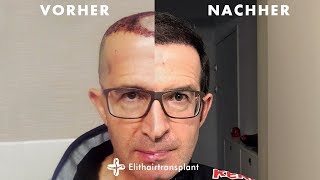 Haartransplantation Vorher Nachher  Elithairtransplant Ergebnisse [upl. by Leunammi]