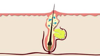 How Acne Develops  Acne Support [upl. by Enelaehs14]