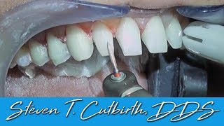 Prepping Teeth for Veneers InDepth Instructions  Dental Minute with Steven T Cutbirth DDS [upl. by Marlin11]