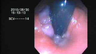 internal hemorrhoids BY DR NASEEM GHOURI [upl. by Mandi]