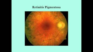 Retinitis Pigmentosa  CRASH Medical Review Series [upl. by Rekoob]