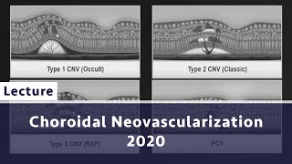 Choroidal Neovascularization 2020 [upl. by Babette215]