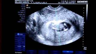 11 weeks twins ultrasound [upl. by Ahsinwad]