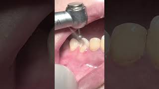 Tooth rebuild with fiber post and composite restoration dentist [upl. by Acilgna]