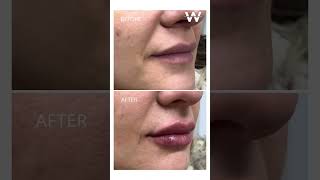 Before amp After Restylane Kysse Lip Fillers [upl. by Ahsinyar]