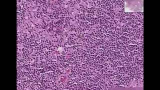 Histopathology Lymph node Metastatic breast carcinoma [upl. by Oinegue821]