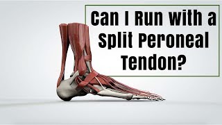 Can I Run with a Split Peroneal Tendon [upl. by Nosak]