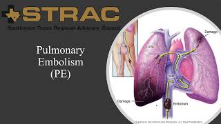 Pulmonary Embolism Response Team PERT [upl. by Ayatnwahs617]