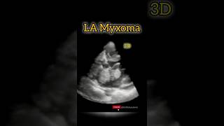 Myxoma in Left Atrium on 3D Echocardiography 3d 3danimation heart [upl. by Neret464]