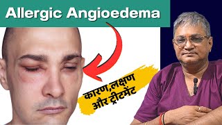 Allergic Angioedema  angioedema treatment  angioedema lips in hindi  angioedema and urticaria [upl. by Davison]