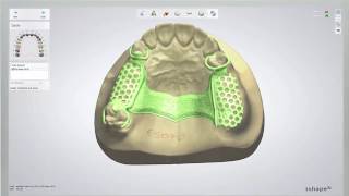 REMOVABLE PARTIAL DENTURE  How its designed  Digital Dentistry [upl. by Jannery225]