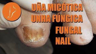 Unha fúngica  Fungal Nail podologiaintegral [upl. by Alios198]