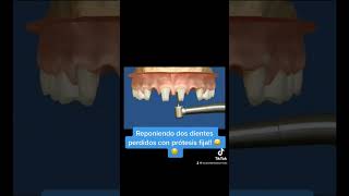 Reponiendo dos dientes perdidos con prótesis fija 😃😌 shorts [upl. by Amaral741]