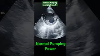 Normal Pumping power of heart in Echo EF5570 shorts echo [upl. by Erdnaet59]