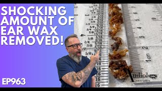 The Most Shocking Ear Wax Removal Ever  EP963 [upl. by Esirec]