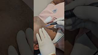 wart removal by Electrocautery machine [upl. by Papke]