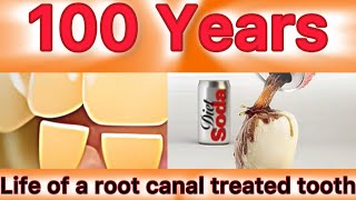 How long does a root canal lastroot canalroot canal treatment [upl. by Pammi]