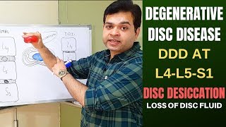 Degenerative Disc Disease DDD L4 L5 L5 S1Disc Desiccation Disc Degeneration Disease Treatment [upl. by Tyoh479]