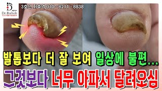 💦내성 amp 무좀 손톱💦색도 모양도 이상하고 아프기까지 해 일상이 힘들어요 🥵 발톱닥터 무좀발톱 무좀발톱스케일링 무좀발톱관리 지축역 무좀손톱 [upl. by Kiri]