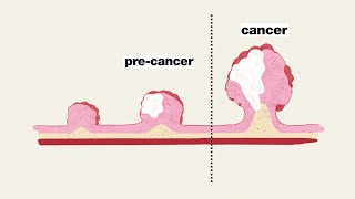 Colorectal cancer screening [upl. by Bekaj]